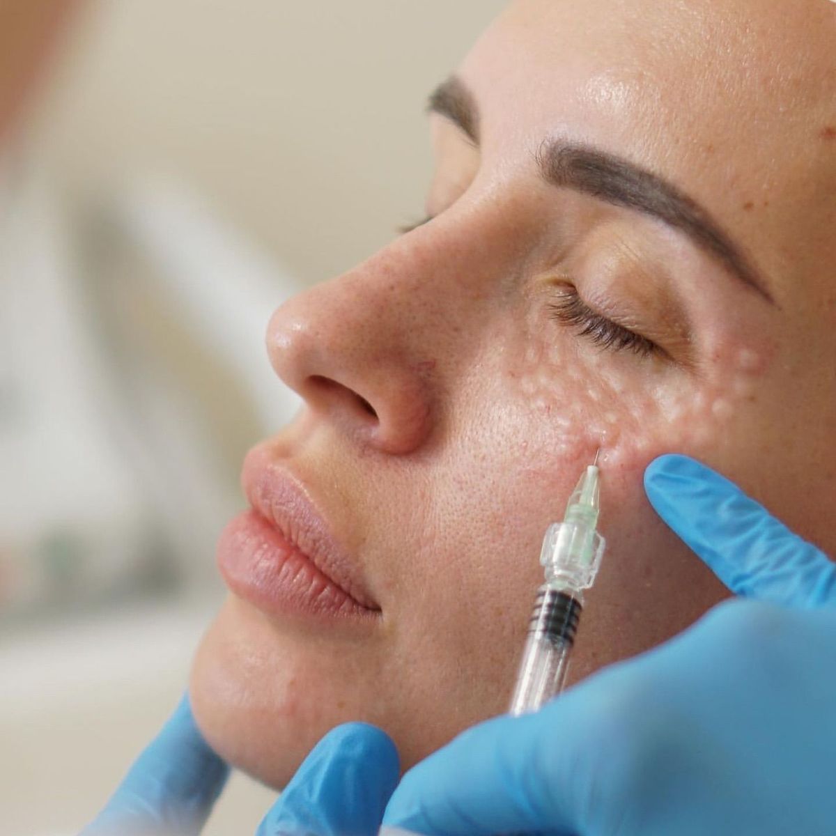 Skin booster (biorevitalization) procedure in an aesthetic medicine clinic